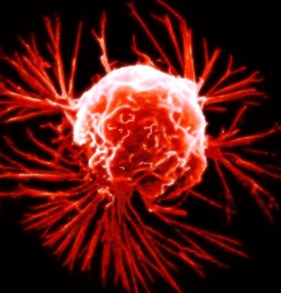 Artist's rendition of a breast cancer cell