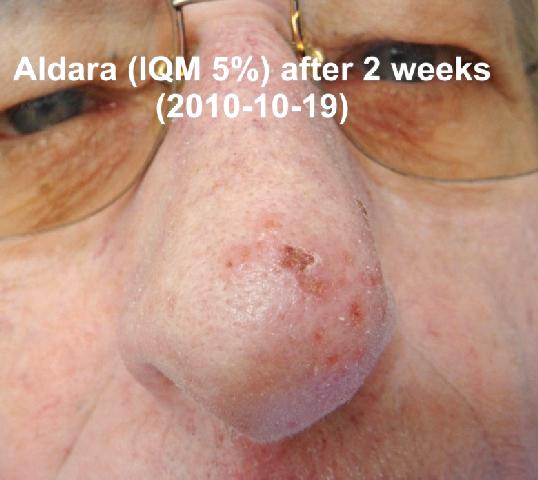 aldara treat herpes